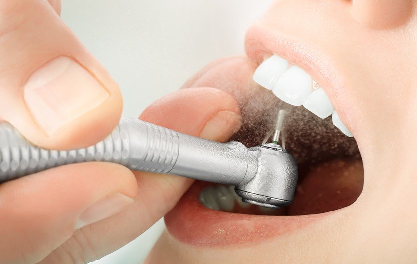 Laser Fillings