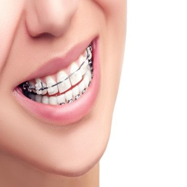 Orthodontics And The Braces